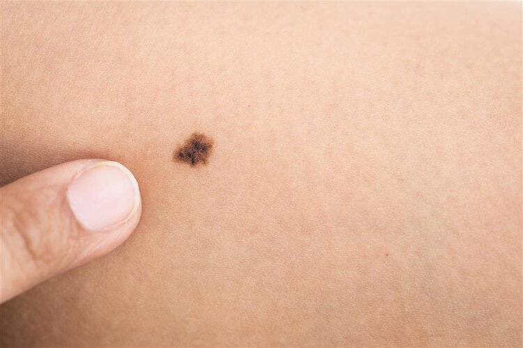 重点提醒：长在3个部位的痣，与癌症“密不可分”，要及时处理