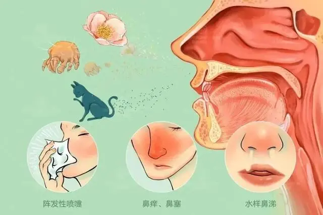 这一种过敏性鼻炎不能只清肺，宁心才能治本