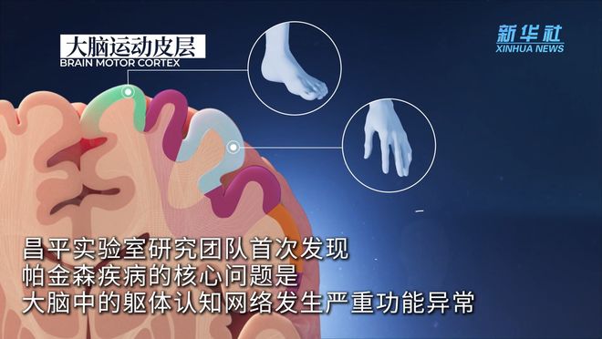 我国科学家世界首次发现帕金森病底层功能网络机制